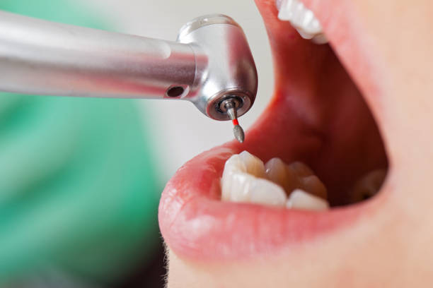 Best Emergency Dentist for Lost Fillings or Crowns in Mullins, SC